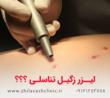 درمان زگیل تناسلی در تهرانسر