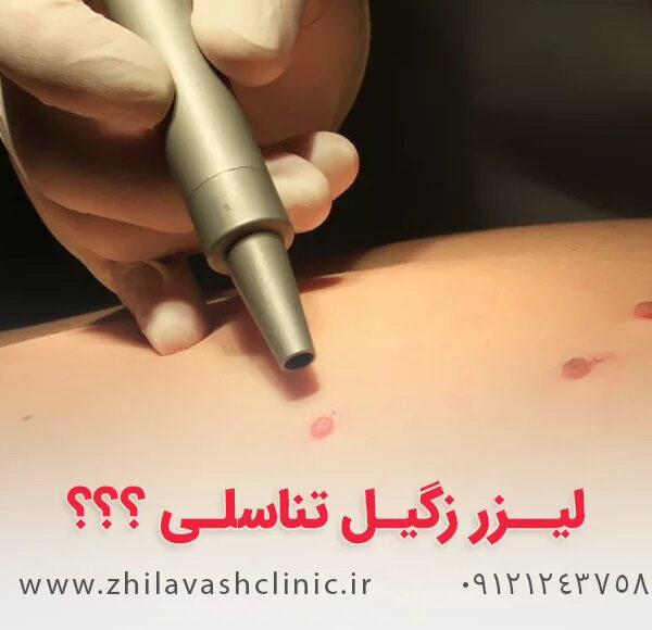 درمان زگیل تناسلی در تهرانسر