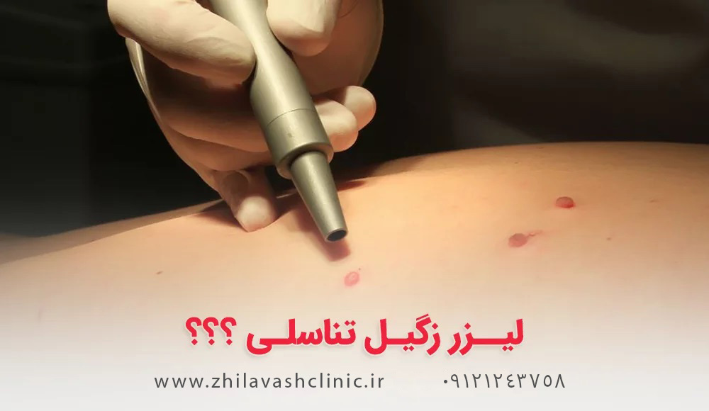 درمان زگیل تناسلی در تهرانسر